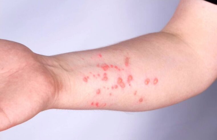 Mpox: Brasil registra 140 casos em 2026